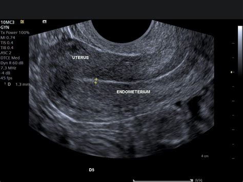 endometrial ultrasound results